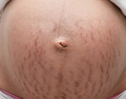 stretch mark